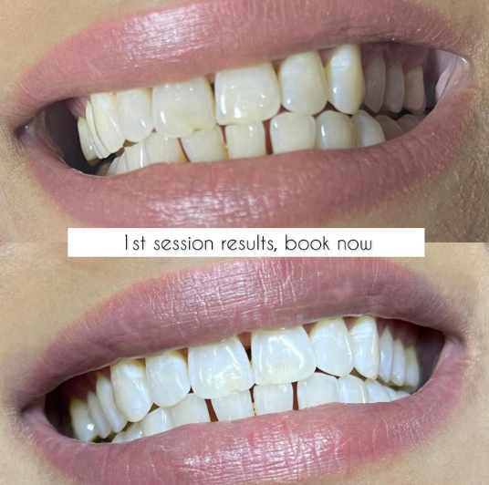 Training in Teeth Whitening - Image 5