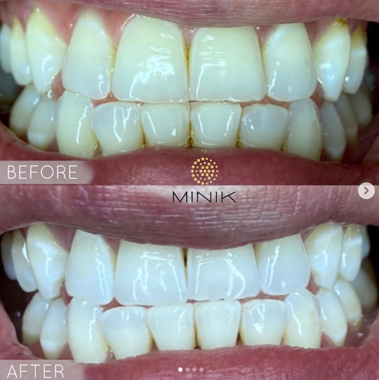 Training in Teeth Whitening - Image 7