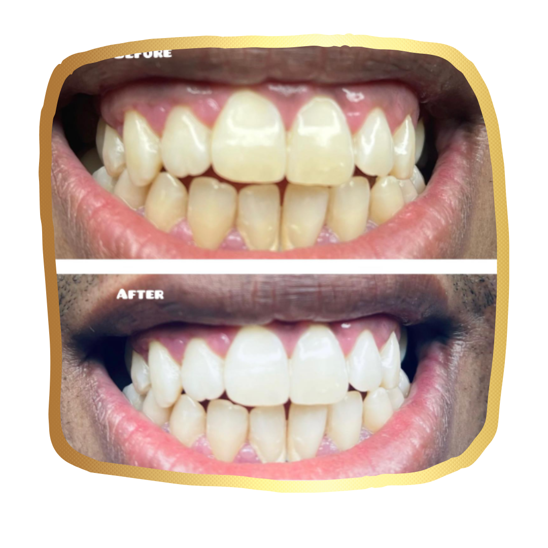 Training in Teeth Whitening - Image 4